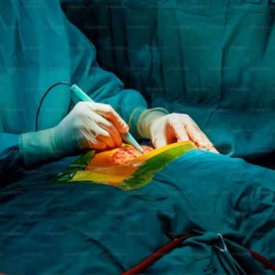 Aortic aneurysm repair