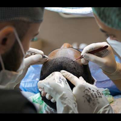 Hair transplant