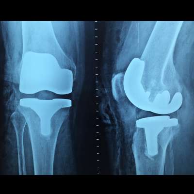 Knee replacement surgery