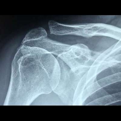 Shoulder replacement surgery