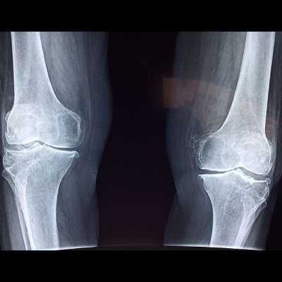 Knee arthroscopy