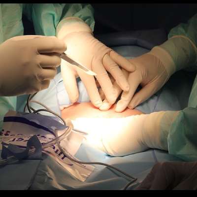 Gastric restrictive surgery