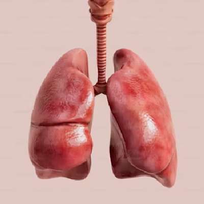 Lung transplant